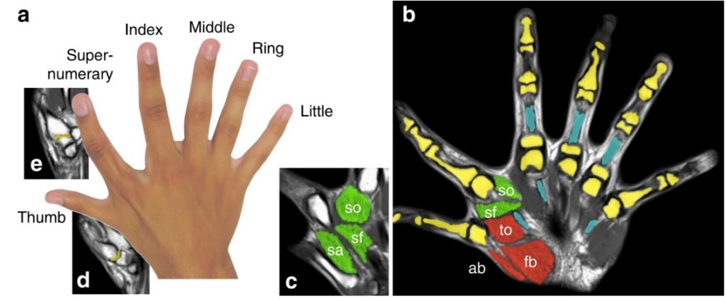 5本指よりも器用?6本指を持つ多指症の人たちの高い能力が明らかに!ー最新研究